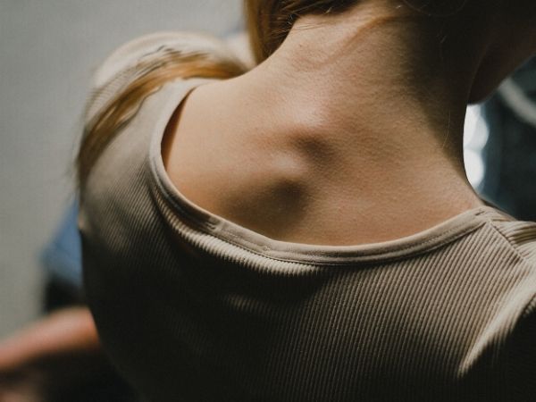 perte de la lordose cervicale
